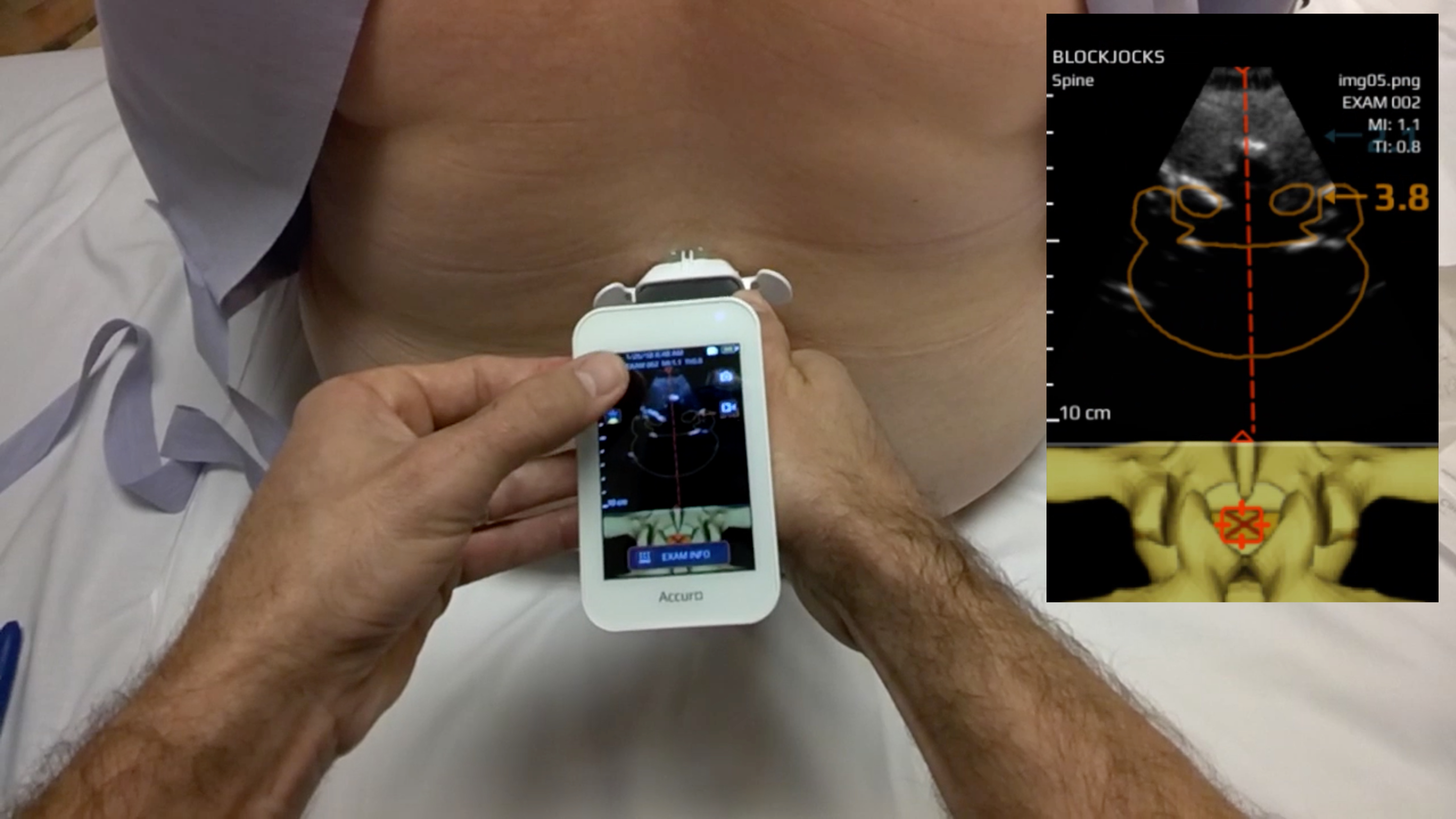 Accuro-Assisted Spinal Using Google Glass