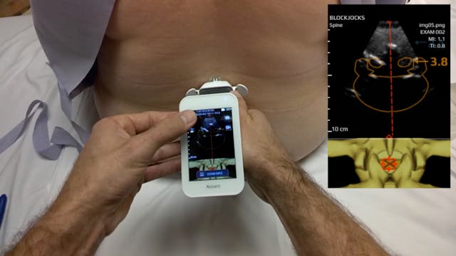 Accuro-Assisted Spinal Using Google G...