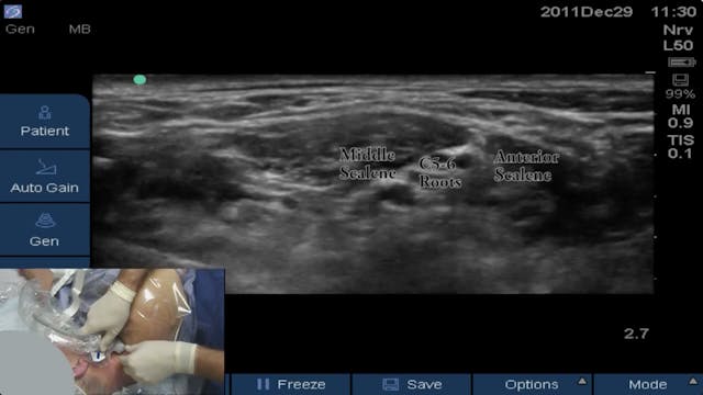Interscalene Catheter