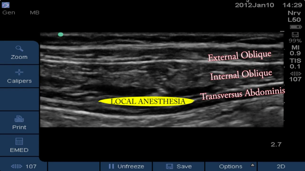 TAP, Quadratus Lumborum, & Rectus Sheath