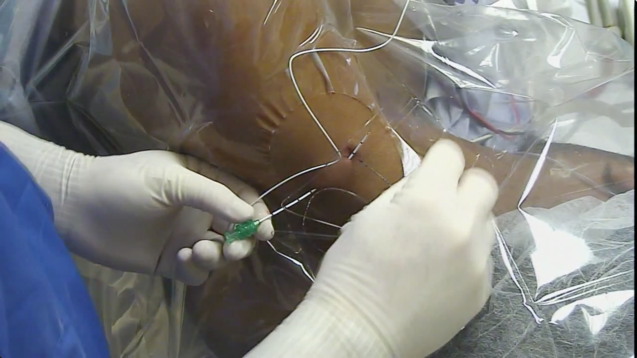 Tunneled Interscalene Catheter