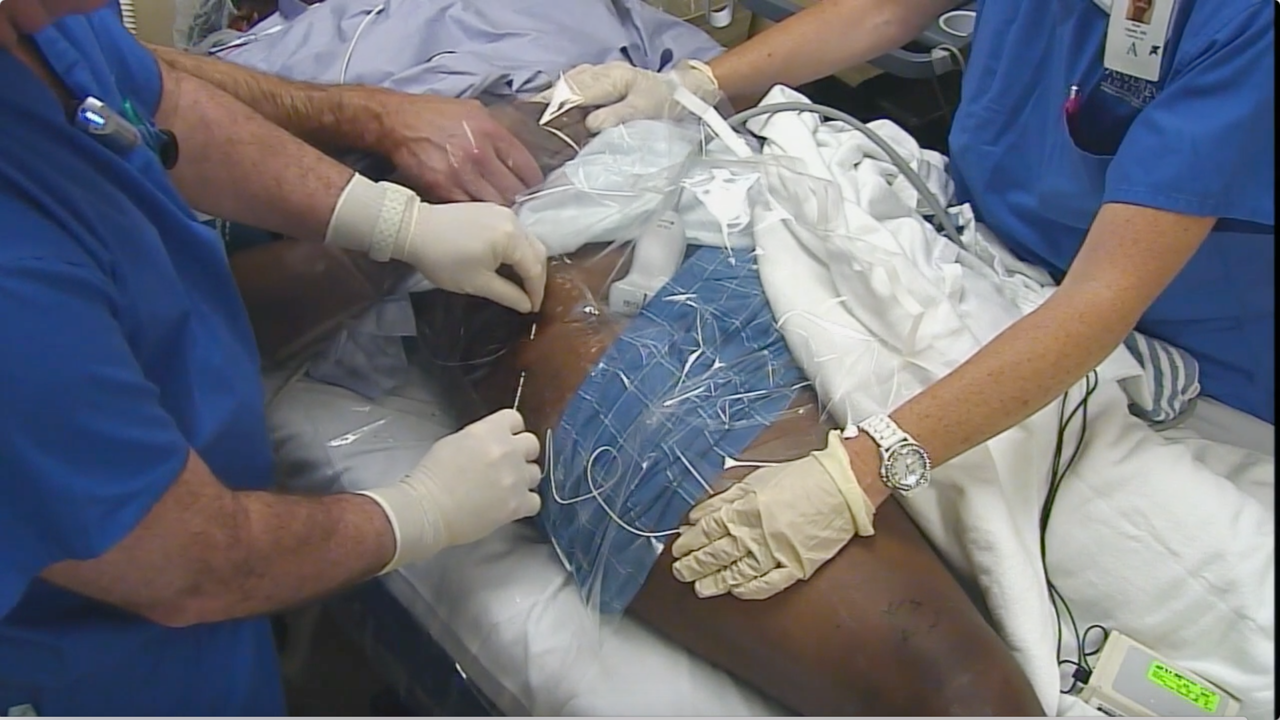 US-Guided Tunneled Femoral Catheter