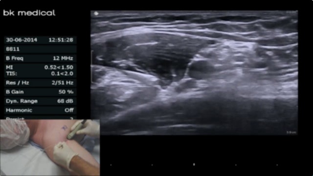 Ultrasound-Guided Axillary Brachial Plexus Block