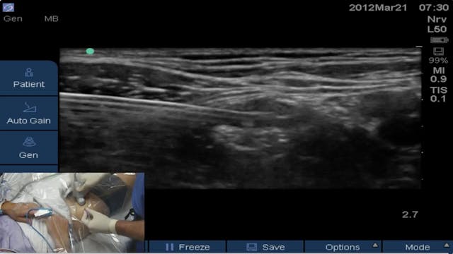 Part 1 of 3: Can a Saphenous/Adductor...