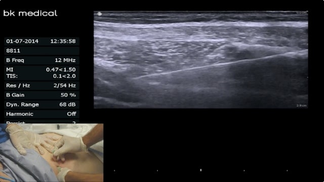 Ultrasound Guided Posterior TAP Block