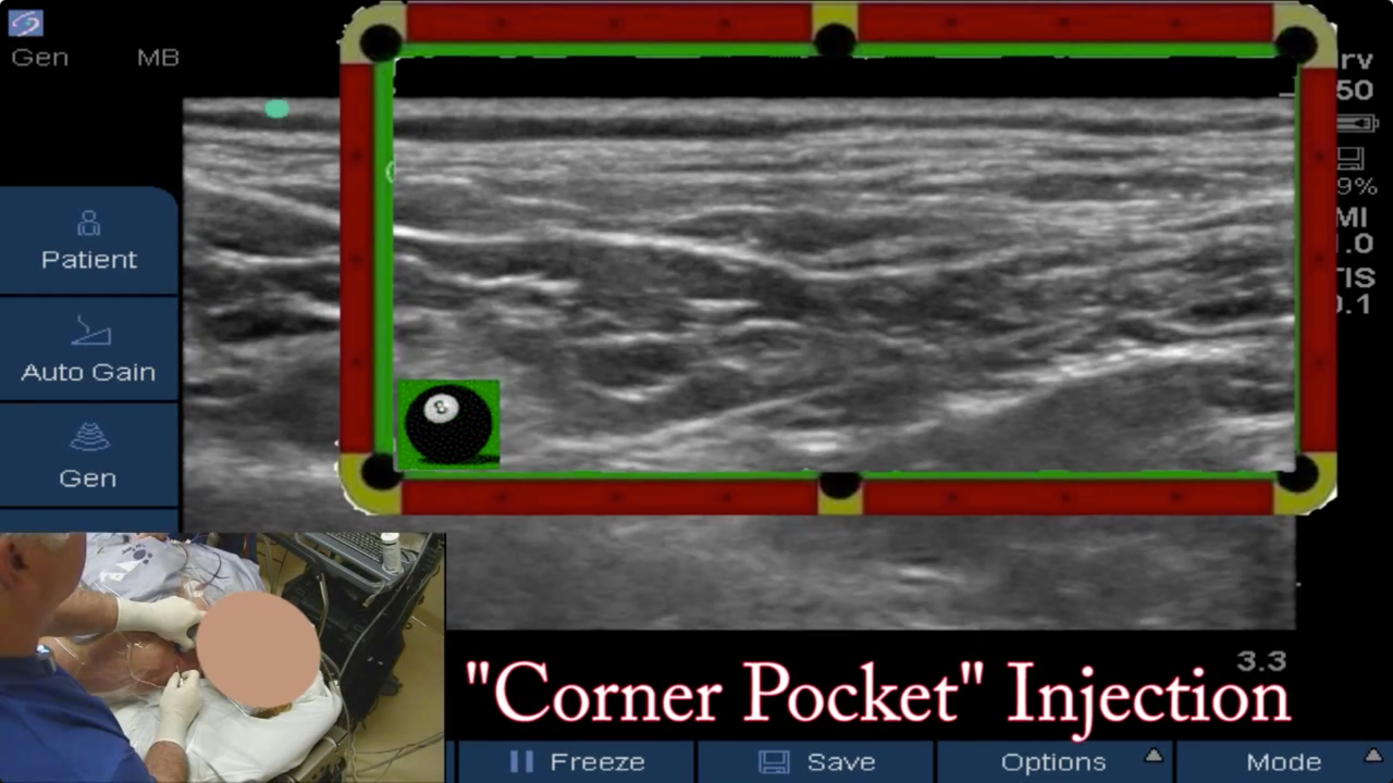 Supraclavicular Catheter