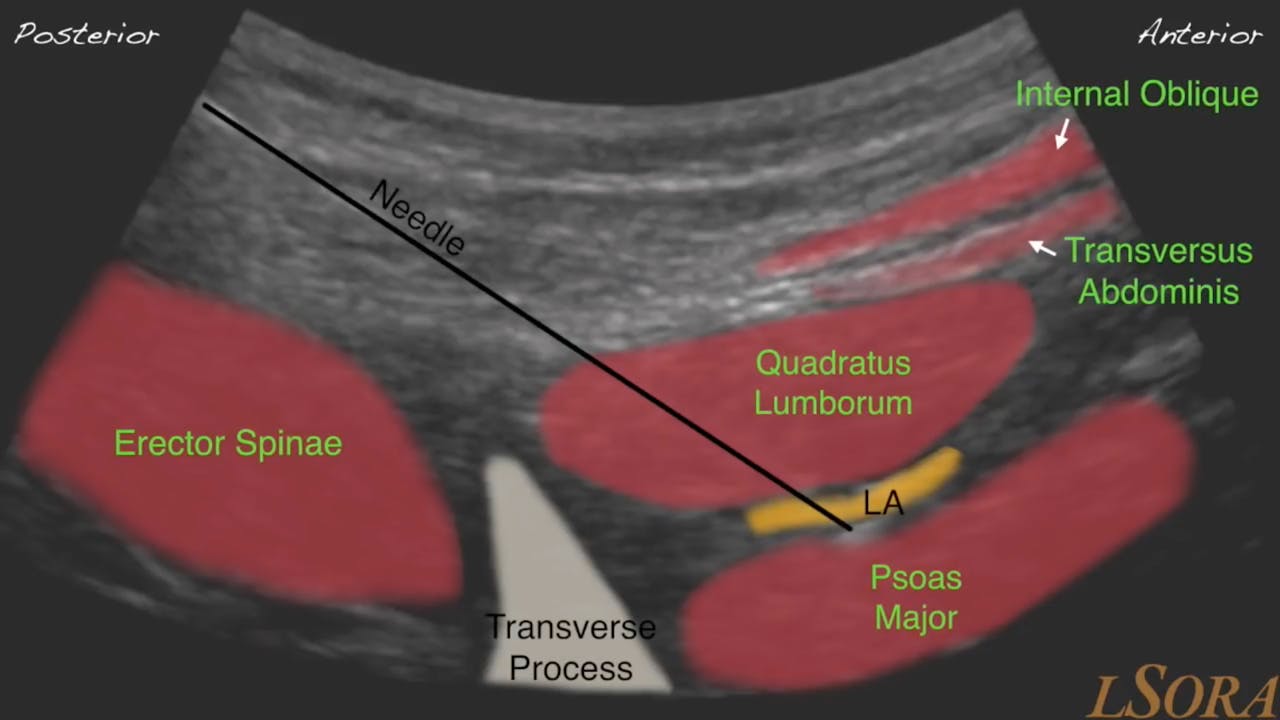 Quadratus Lumborum Ql3 Block Usg Guided Youtube