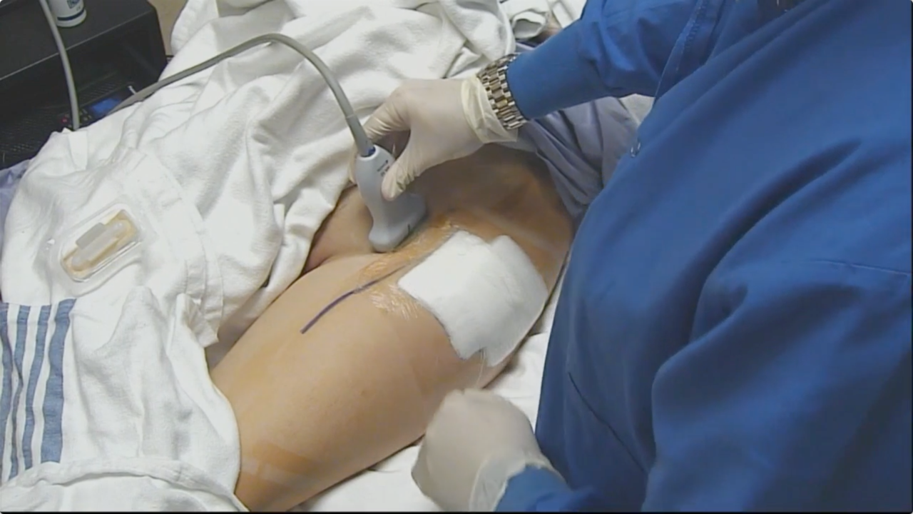 US-Guided Fascia Iliaca Block