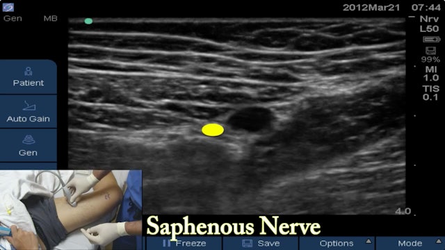 Part 2 of 3: Can a Saphenous/Adductor Canal Block Replace a Femoral for ACL? Saphenous/Adductor Canal Block