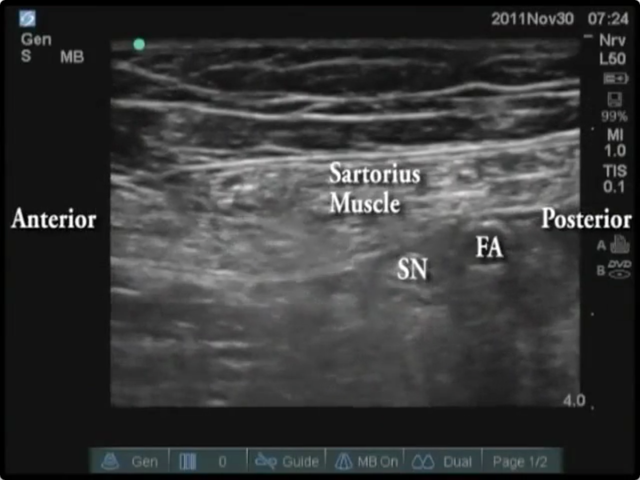 4: Ultrasound-Guided Mid-Thigh Saphenous Nerve Block