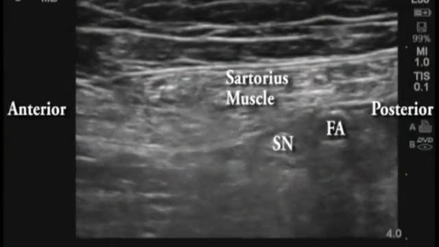 4: Ultrasound-Guided Mid-Thigh Saphen...