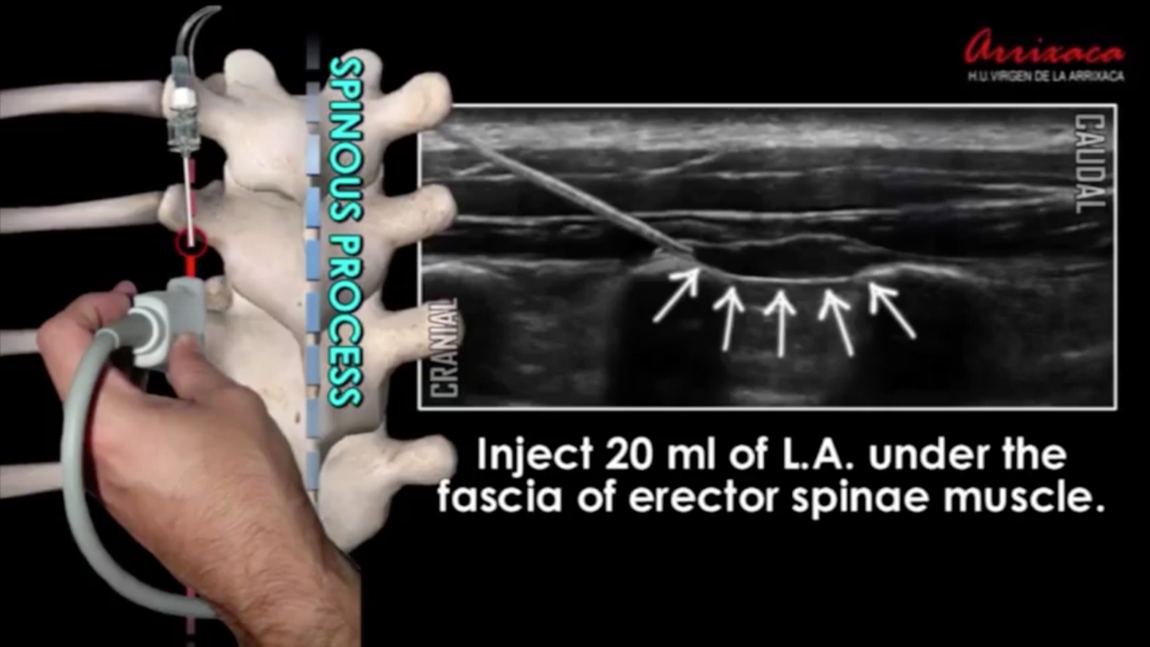 Erector Spinae Plane (ESP) Blocks