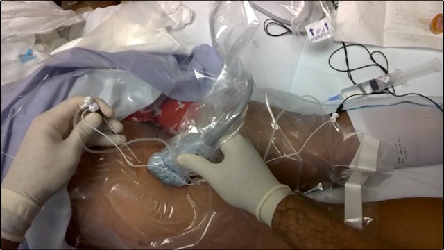 US-Guided Subgluteal Sciatic Cath with Google Glass