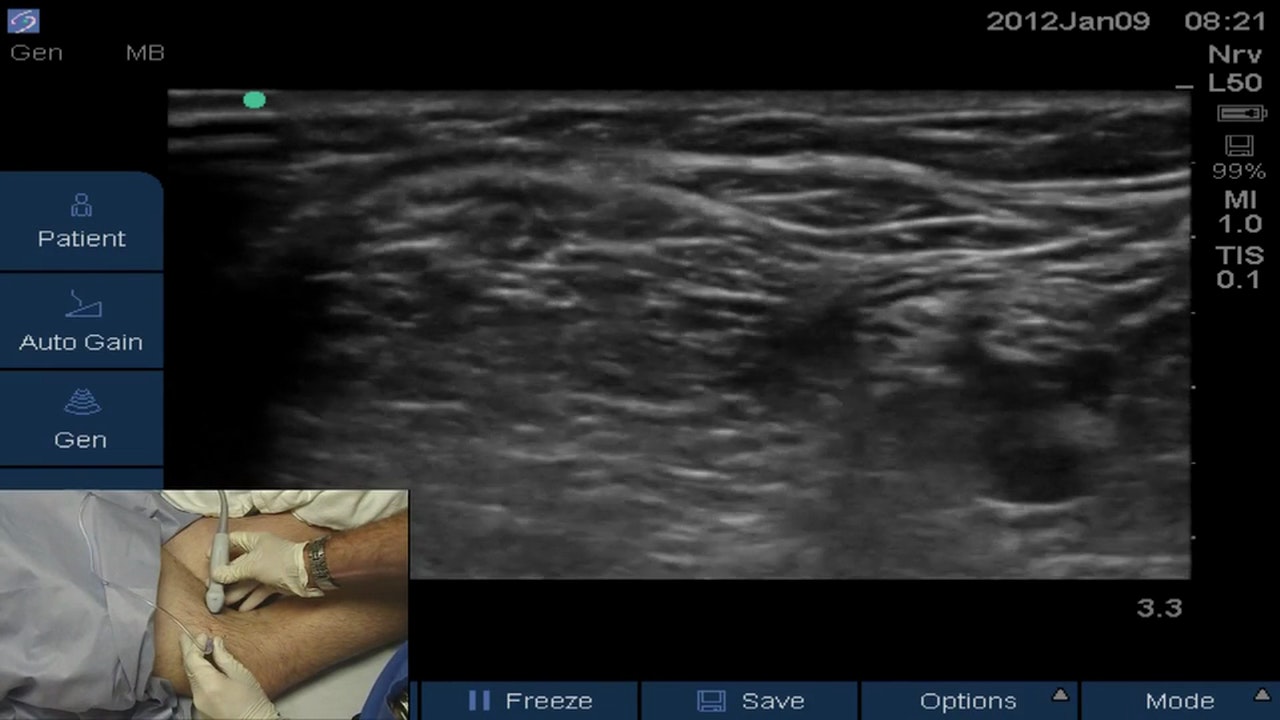 Popliteal Block - Free Procedure Videos - BLOCKJOCKS.COM