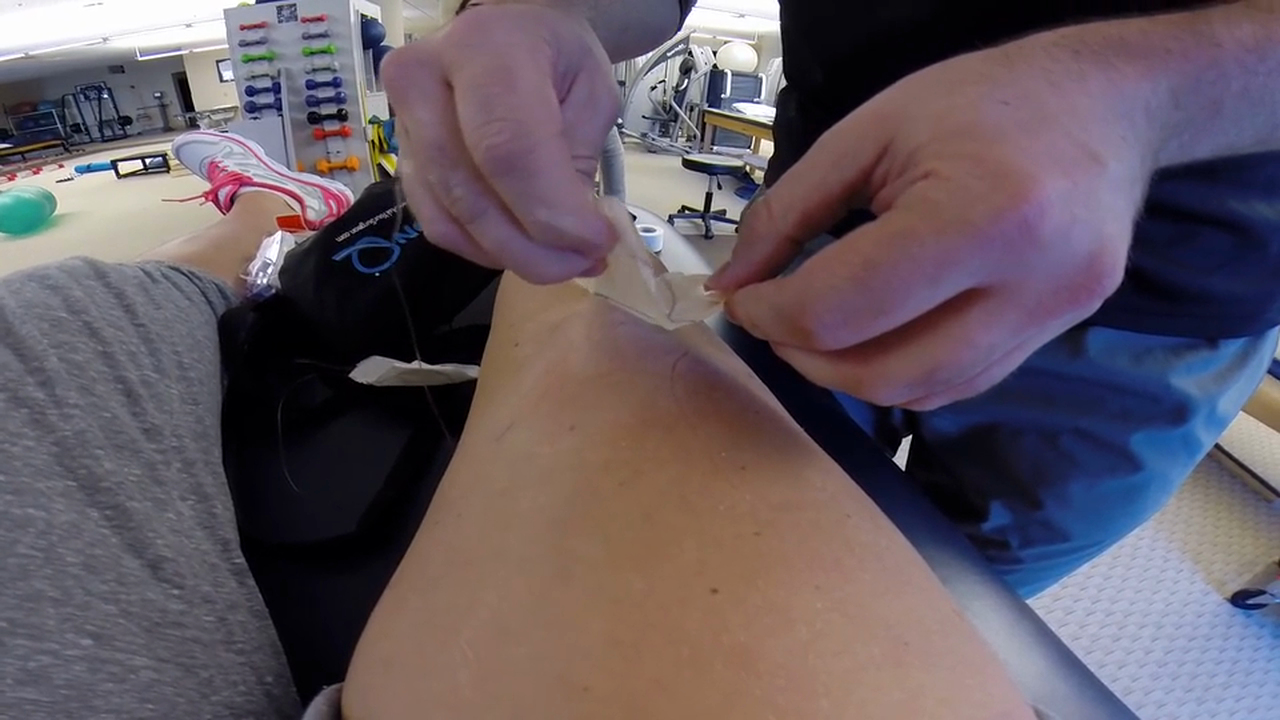 Lindsey Vonn Removes Her Adductor Canal Catheter