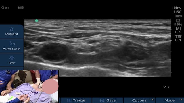 New Ultrasound Guided Supraclavicular Block Supraclavicular