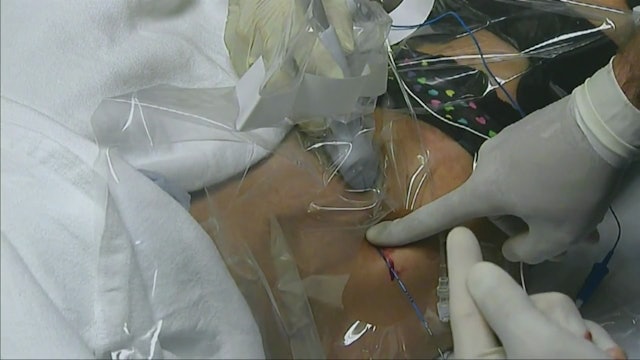US-Guided Femoral Catheter with Arrow StimuCath
