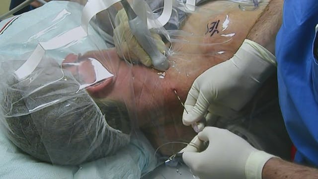 Interscalene Styleted Catheter