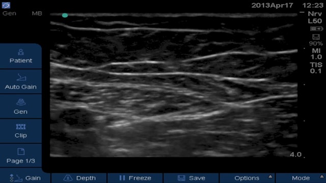Attempted Obturator Block in Adductor Canal