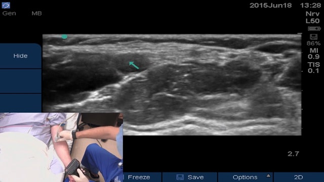 Ultrasound-guided Peripheral IV Placement