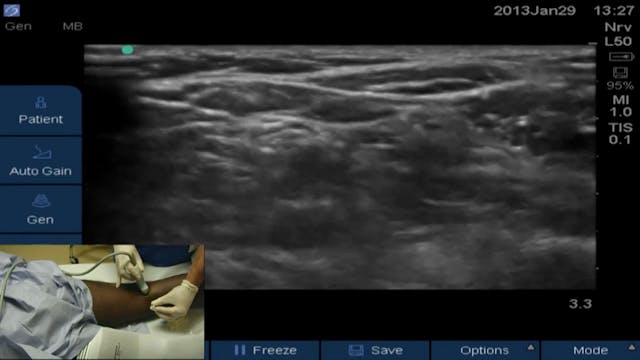 US-Guided Tibial Block