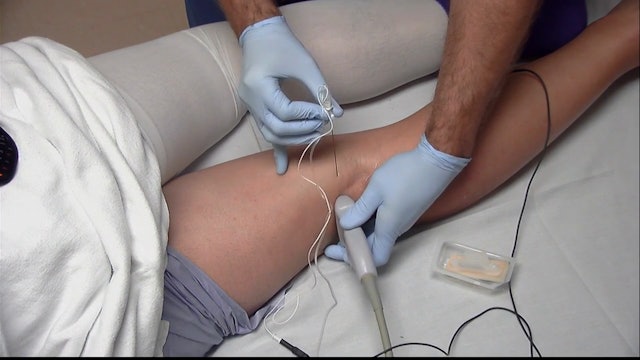 Modified Lateral Tibial Nerve Block with Ultrasound
