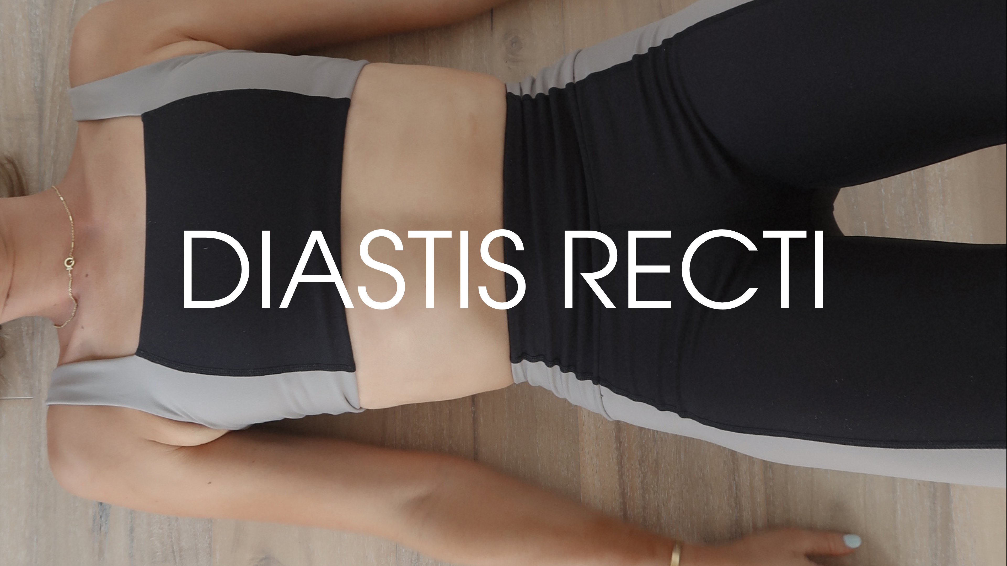 Diastisis Recti (PDF)