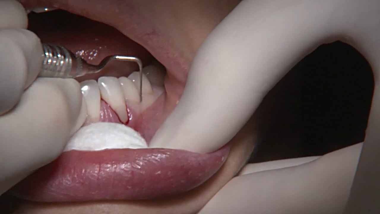 C1-12 Mandibular Anterior with Deep Recession and Cervical Restorations