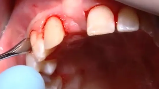 C2-8 Palatal Pedicle CTG with Tunnel Technique for Implant Site Development