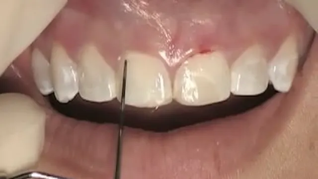 C2-4 Esthetic Crown Lengthening by Apically Positioned Flap