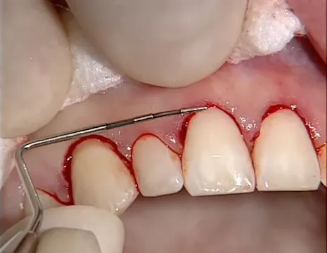 C2-3 Esthetic Crown Lengthening