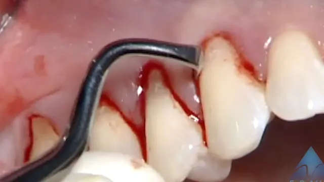 C1-4 Coronally Positioned Pouch Procedure