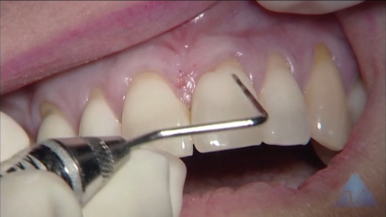 C1-8 AlloDerm Grafting of Multiple Maxillary Teeth with Root Notching