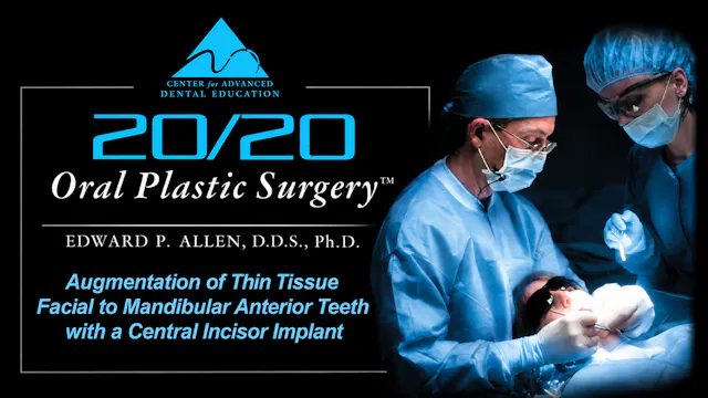 13 Aug of Thin Tissue at LA Teeth & Implant