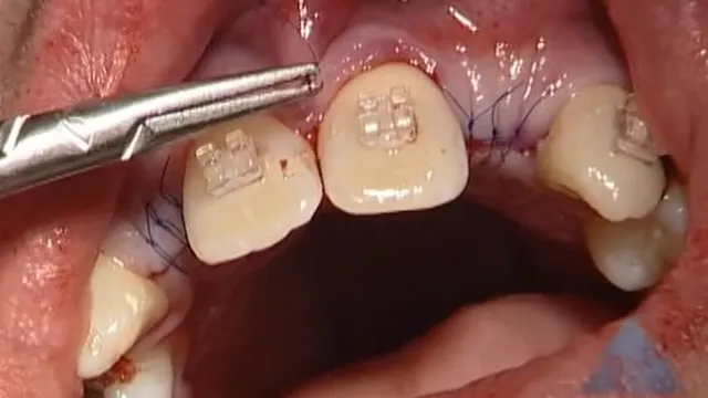 C2-6 Allogenic Block & Particulate Bone Graft at Maxillary Lateral Incisor Sites