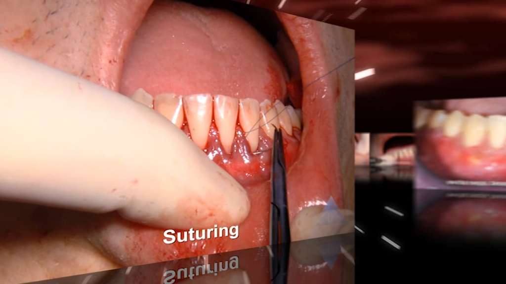 C1-11 AlloDerm Grafting, Mandibular Left Quadrant