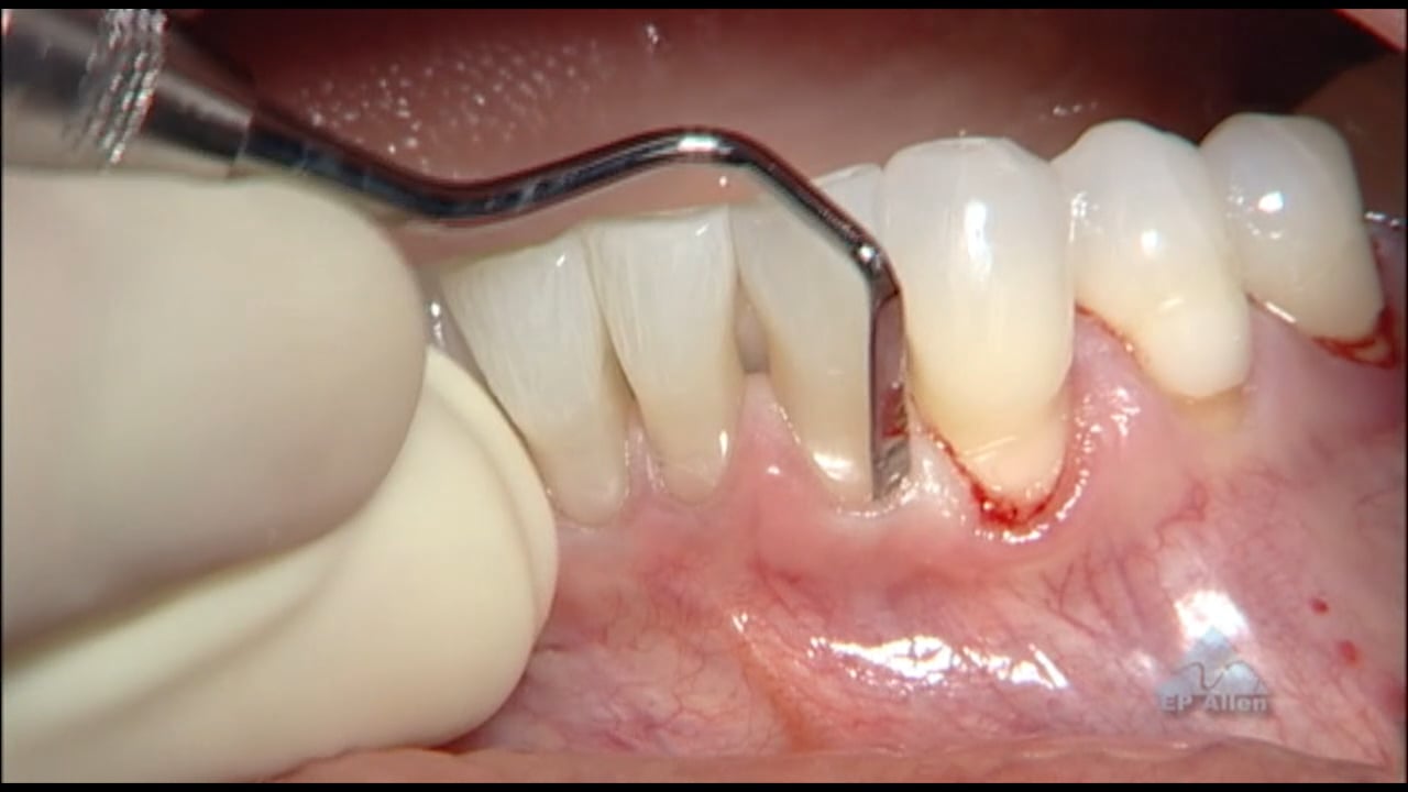 C1-2 AlloDerm Grafting: Class III Recession with Cervical Notching