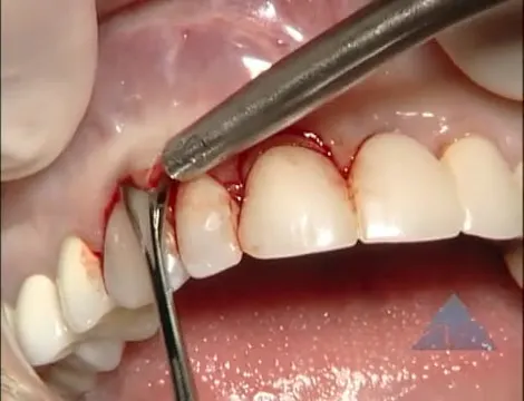 C2-2 Soft Tissue Ridge Augmentation with Esthetic Crown Lengthening