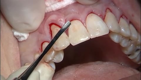 C1-1 AlloDerm Grafting in the Esthetic Zone to Correct Failed CTG