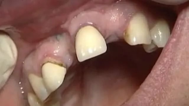 C2-5 Allogenic Block Graft at Site of Tooth Lost to Endodontic Failure