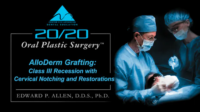 2 ADM Graft for CL III REC with Cervical Notching