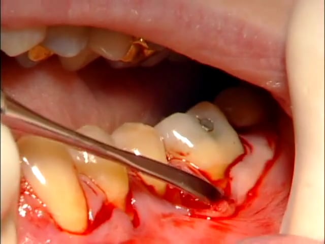 C1-5 Alternate Papilla Tunnel Technique