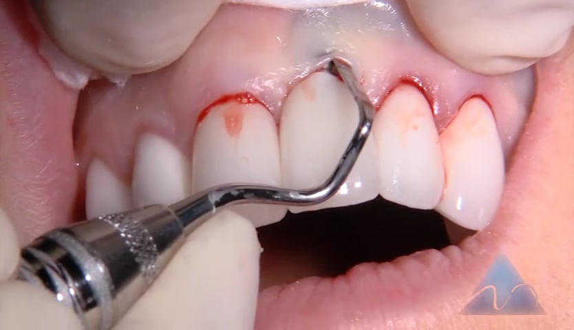 C1-9 Solving Implant Soft Tissue Defect in the Esthetic Zone
