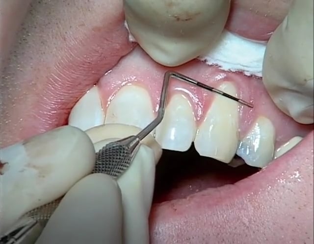 C1-6 Connective Tissue Graft