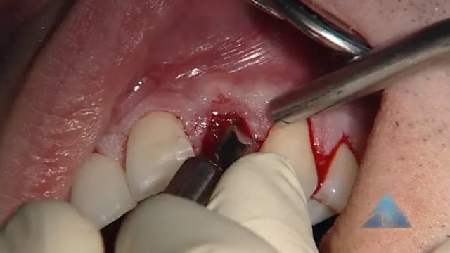 C2-7 Lateral Ridge Augmentation with SonicWeld Rx Resorbable Rigid Membranes