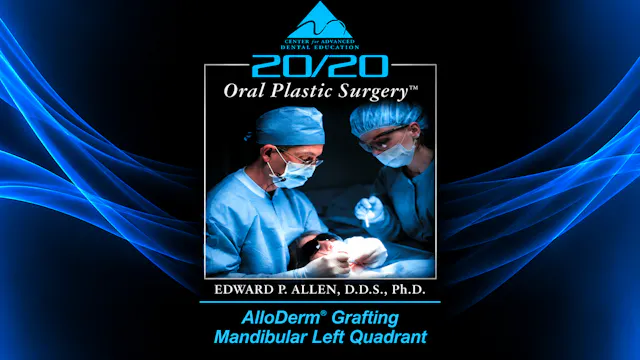 11 ADM Grafting, Mandibular Left Quadrant