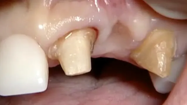 C2-1 Soft Tissue Ridge Augmentation with Papilla Elevation