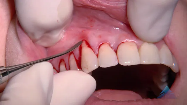 C1-10 AlloDerm Grafting, Maxillary Right Quadrant with Cervical Restorations