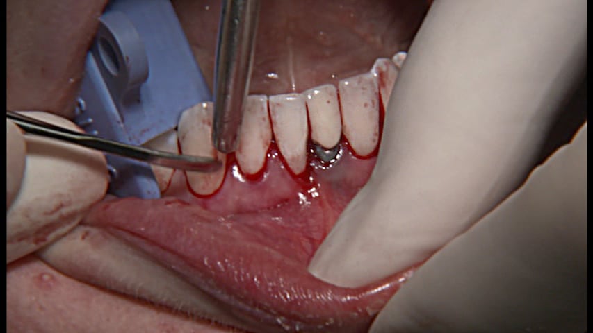 C1-13 Augmentation of Thin Tissue Facial to Mandibular Anterior Teeth & Implant