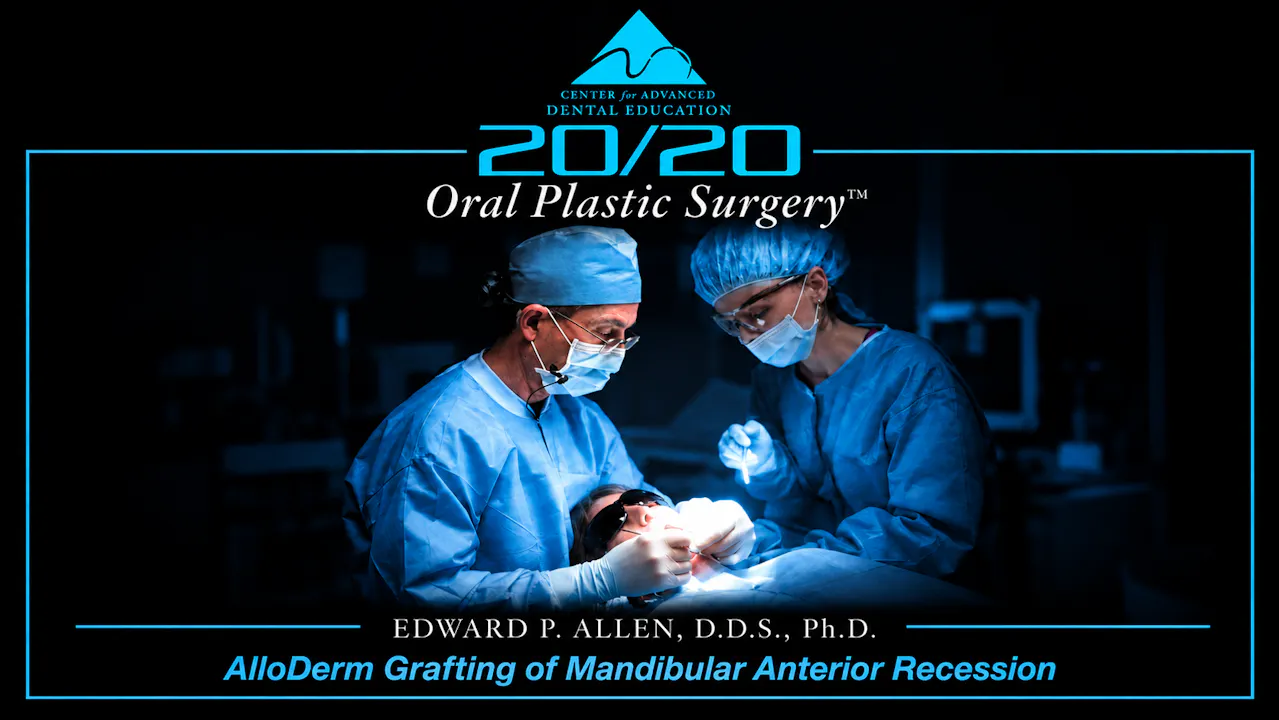 3 ADM Grafting of Mandibular Anterior Recession